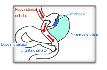 http://www.sicob.org/interventi/immagini/bypassgastrico04.jpg